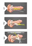Pumped Penis Extender Peniksenvenytin - Peniksen pidennys - 8714273926005 - 5